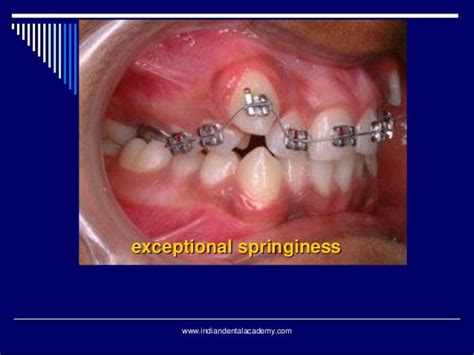 Orthodontic Wires Certified Fixed Orthodontic Courses By Indian Dent