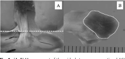 Figure 1 From Size Comparison Of The Cadaveric Anterior Cruciate