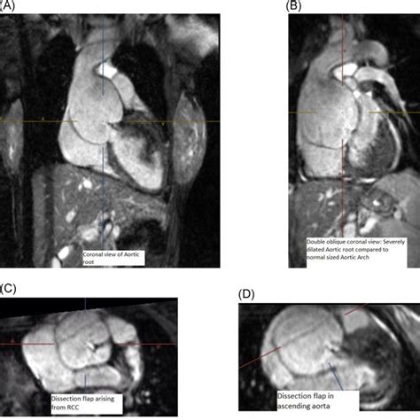 Chest CTA With Contrast Showing Preoperative Acute DeBakey Type I