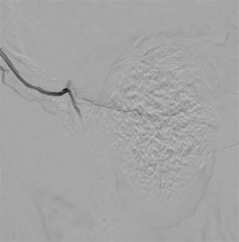 Embolisation De La Prostate La Radiologie Interventionnelle Pau