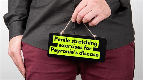 Penile Stretching Exercises For Peyronies Disease