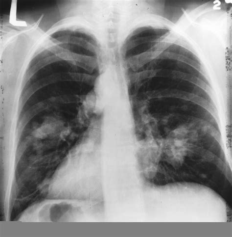 Fichier:X-ray(Chest)Cancer.jpg — Wikipédia