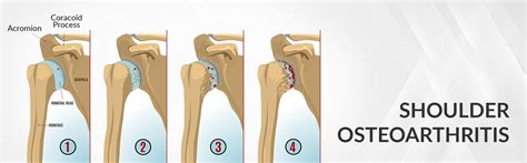 Shoulder Osteoarthritis - Dr. Saurabh Aggarwal