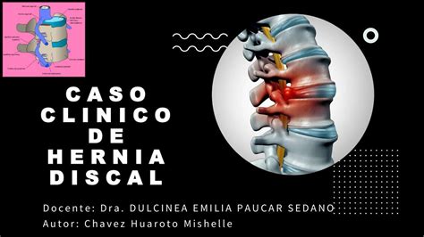 Caso Cl Nico De Hernia Discal Mishelle Chavez Udocz