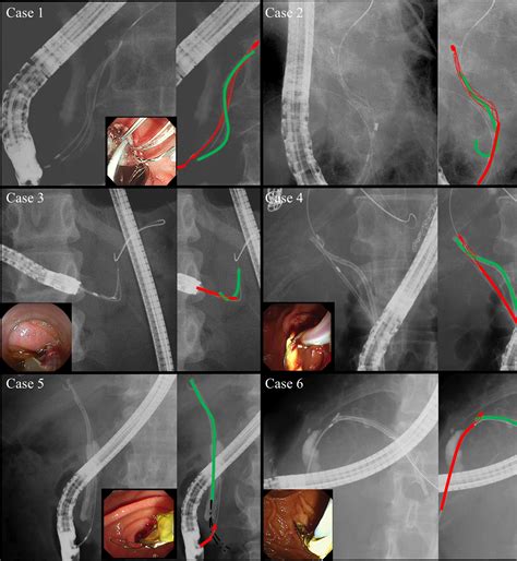 Endoscopic Retrieval Device For Proximally Migrated Pancreatic And