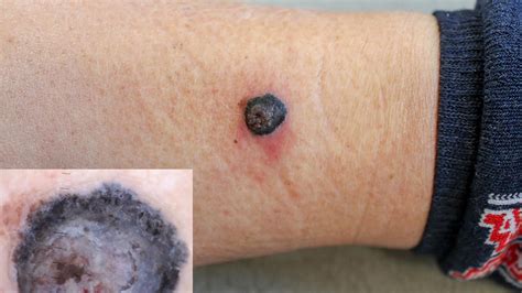 Blood Blister Vs Melanoma How To Tell The Difference