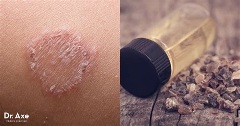 Ringworm Treatment: Try These 6 Natural Remedies - Dr. Axe