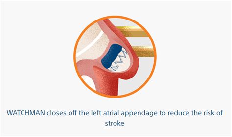 Watchman Procedure - Colorado Heart & Vascular