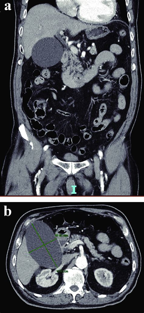 Coronal A And Axial View B Of A Contrast Enhanced Abdominal CT Scan