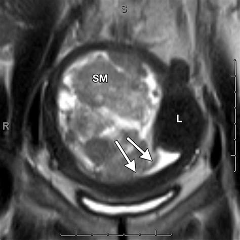 Role Of Mr Imaging Of Uterine Leiomyomas Before And After Embolization