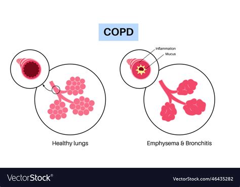 Chronic Obstructive Pulmonary Disease Royalty Free Vector