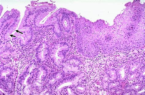 Image 7 Esophagus Metaplasia Barrett Metaplasia