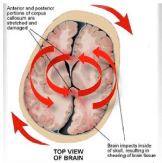 Neuro 3 3 Pathophys Of TBI And Other Disorders Flashcards Quizlet