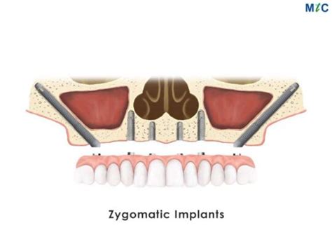 Zygomatic Implant