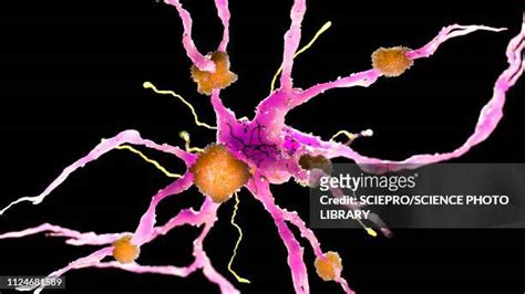 Amyloid Plaques Brain Photos and Premium High Res Pictures - Getty Images