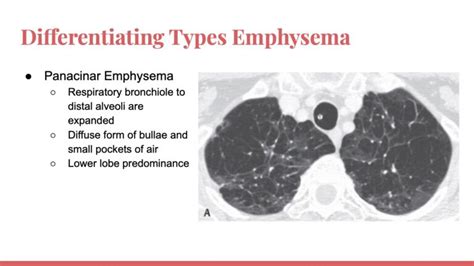 Radiology Presentation Emphysema Imaging Jordan Villaruel