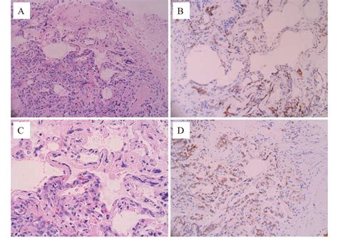 Figure 2 From A Case Of Intravascular Large B Cell Lymphoma Ivlbcl With No Abnormal Findings