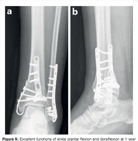 Lateral Malleolus Hook Plate Fixation In The Treatment Of Herscovici Type B Medial Malleolar