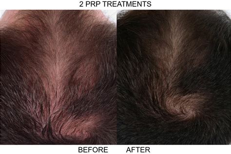 Prp Hair Loss Knoxville Center For Dermatology And Plastic Surgery