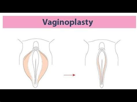 Vaginoplasty Surgery A Step By Step Look Into Vaginal Reconstruction