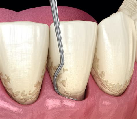 What Is Scaling Root Planing My Dental Advocate