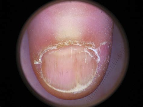 Treating Nail Lichen Planus During The Covid 19 Pandemic Dermatology