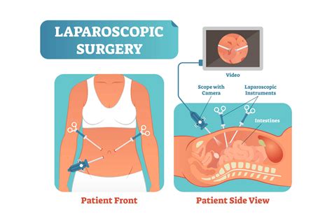 Laparoscopy For Infertility Treatment Does It Help In Getting