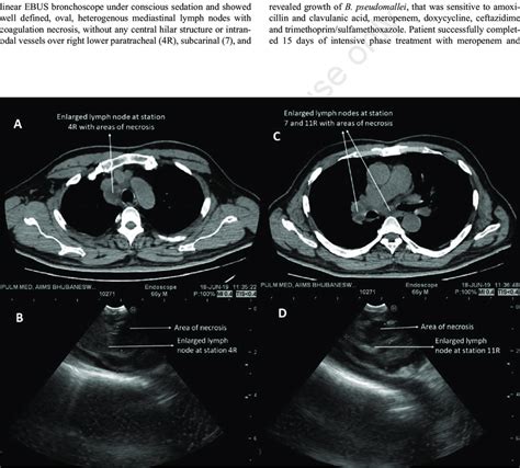 Enlarged Mediastinal Lymph Nodes