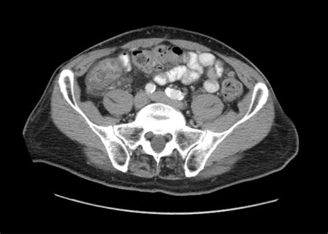 Imaging Findings of Small Bowel - Diverticulitis: A Case Report - JETem