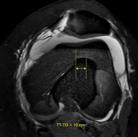 Tibial Tuberosity To Trochlear Groove Distance Tt Tg Distance