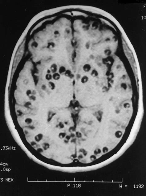 Taeniasis And Cysticercosis As A Result Of Tapeworm Infection Youmemindbody