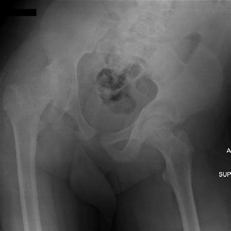 Anteroposterior Ap Pelvis Radiograph Showing Bilateral Percutaneous