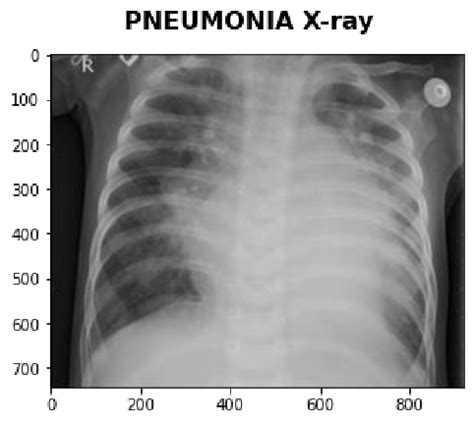 Sample of X-ray image classified as pneumonia drawn from the dataset.... | Download Scientific ...