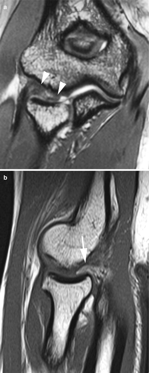 Medial Collateral Ligament Elbow Mri