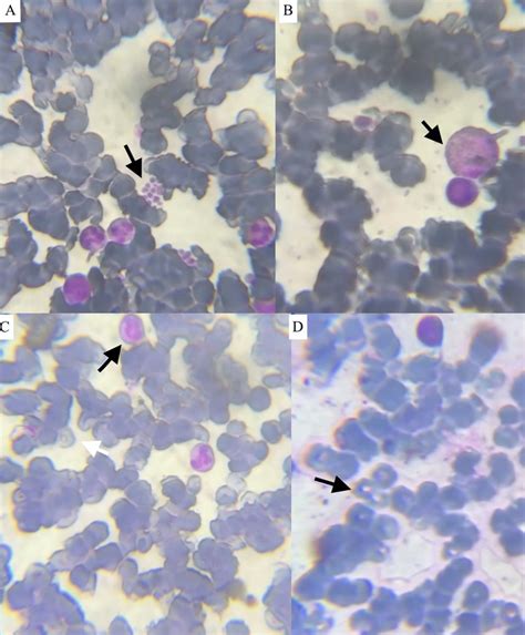 Classic Illustration Of Plasmodium Vivaxplasmodium Falciparum Coinfection Bmj Case Reports