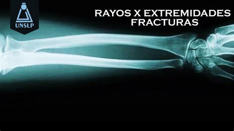 Rayos X Extremidades Fracturas Kruz Machicado Udocz