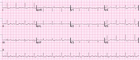 Dr Smiths Ecg Blog Is This St Depression Due To Omi Or Due To