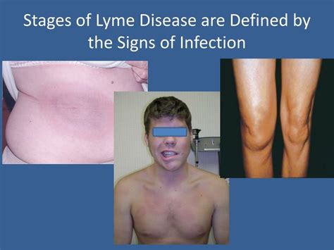 Ppt Lyme Disease And Post Treatment Lyme Disease Syndrome Powerpoint Presentation Id2362370