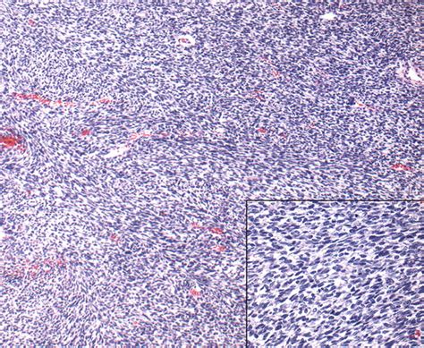 Airp Best Cases In Radiologic Pathologic Correlation Congenital Mesoblastic Nephroma