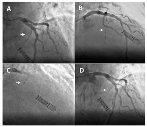 JCM Free Full Text Alcohol Septal Ablation In Patients With