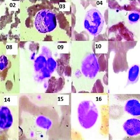 Photomicrographs Of Peripheral Blood Morphological Features Of Severe