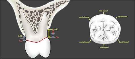 Measurement Of Alveolar Bone Loss In Patients And In Cbct Images The