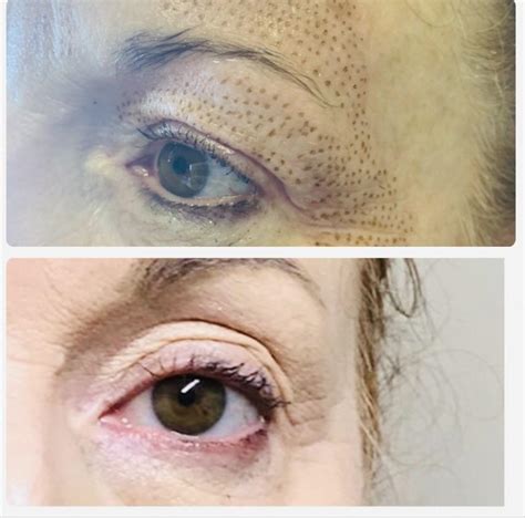 Album Semi Permanent Eyebrow Natural Enhanced Beauty Clinic Leeds