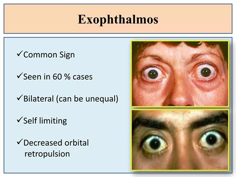 Real Thyroid Ophthalmopathypptx