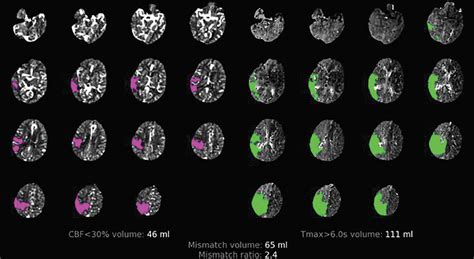 RAPID Automated CT Perfusion In Clinical Practice Practical Neurology