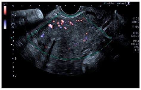 Tomography Free Full Text Identification Of Pelvic Congestion