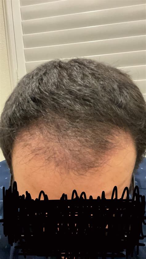 3 month hair transplant progress : r/HairTransplants