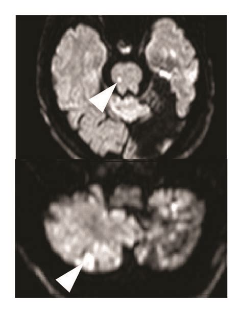 A Top Sagittal T Weighted Contrast Enhanced Brain Magnetic