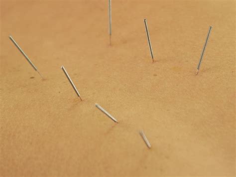 What Are The Benefits Of Dry Needling For Athletes