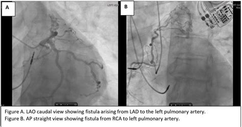 Coronary To Left Pulmonary Artery Fistula A Case Report Journal Of